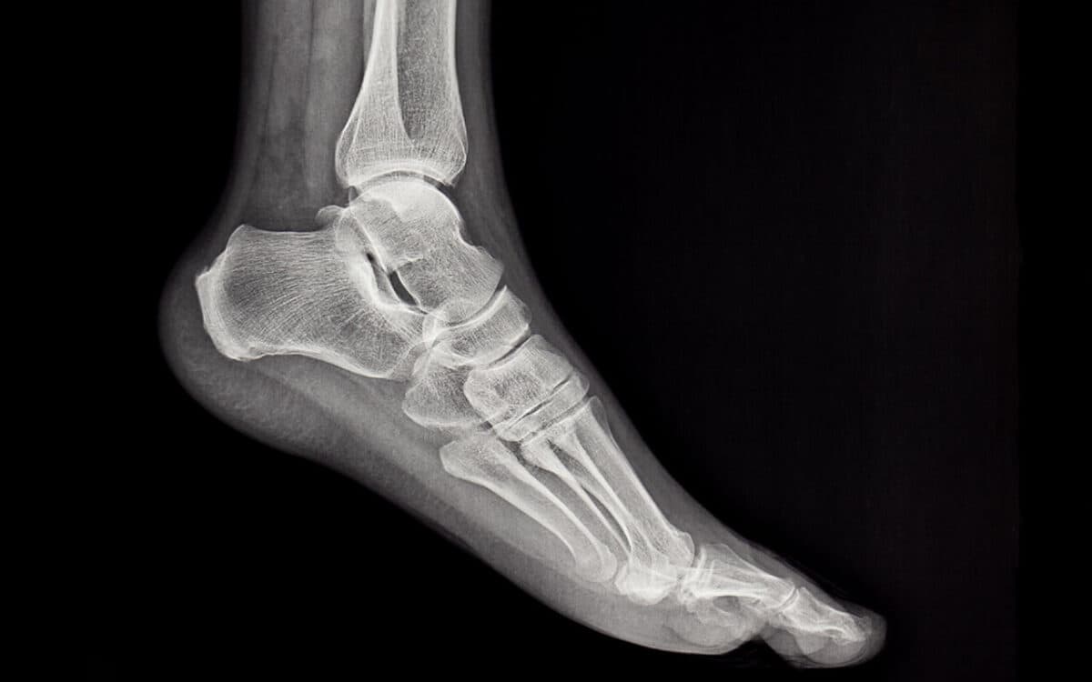X-ray of a foot and ankle